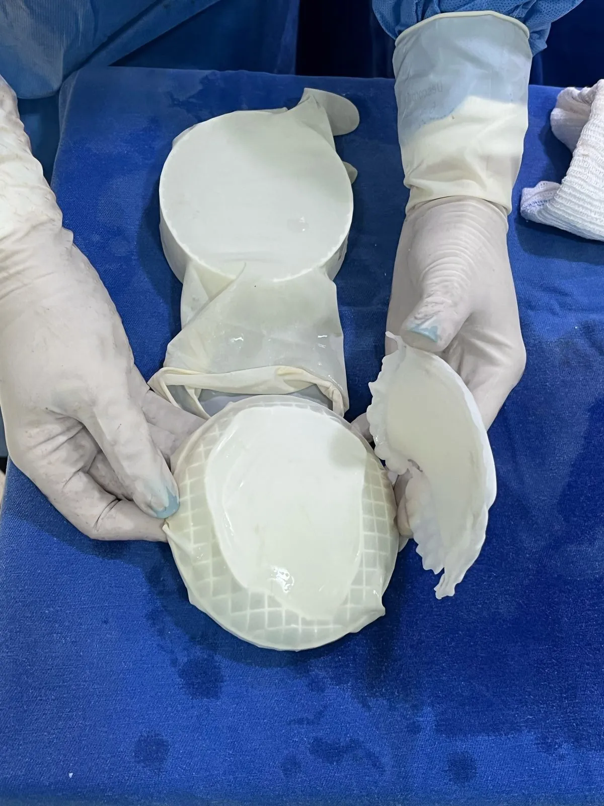 Tecnologia: HUOP realiza primeira cirurgia craniana com molde criado em impressora 3D