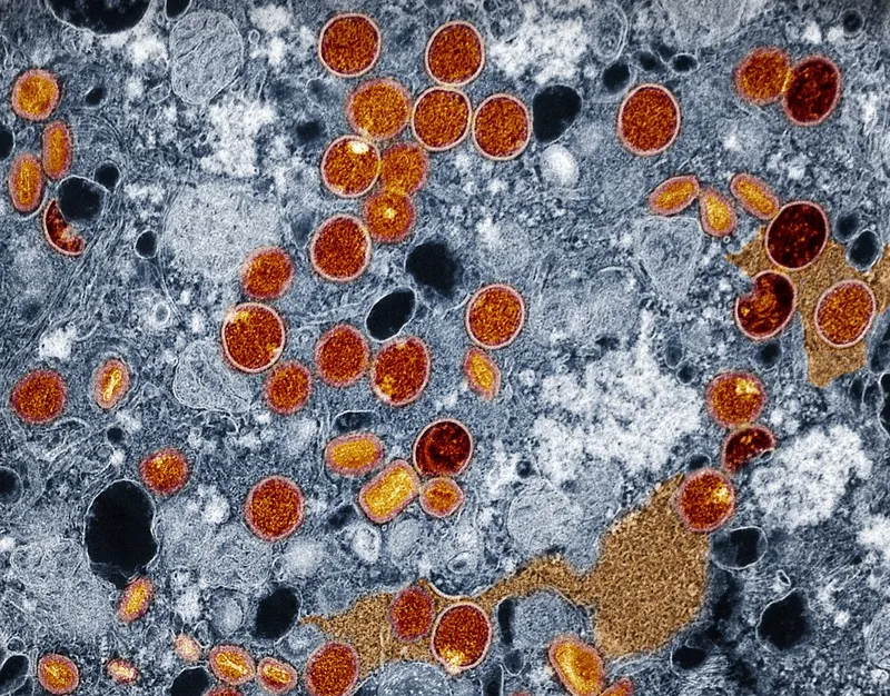 Região Norte do Brasil registra casos de mpox