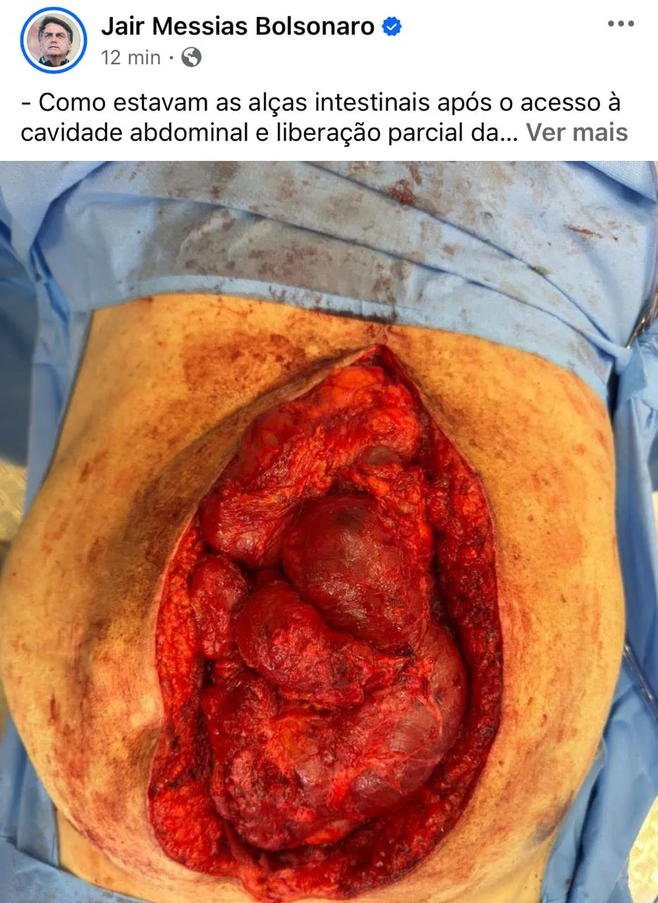 Bolsonaro publica imagem perturbadora de seu abdômen aberto e assusta internautas