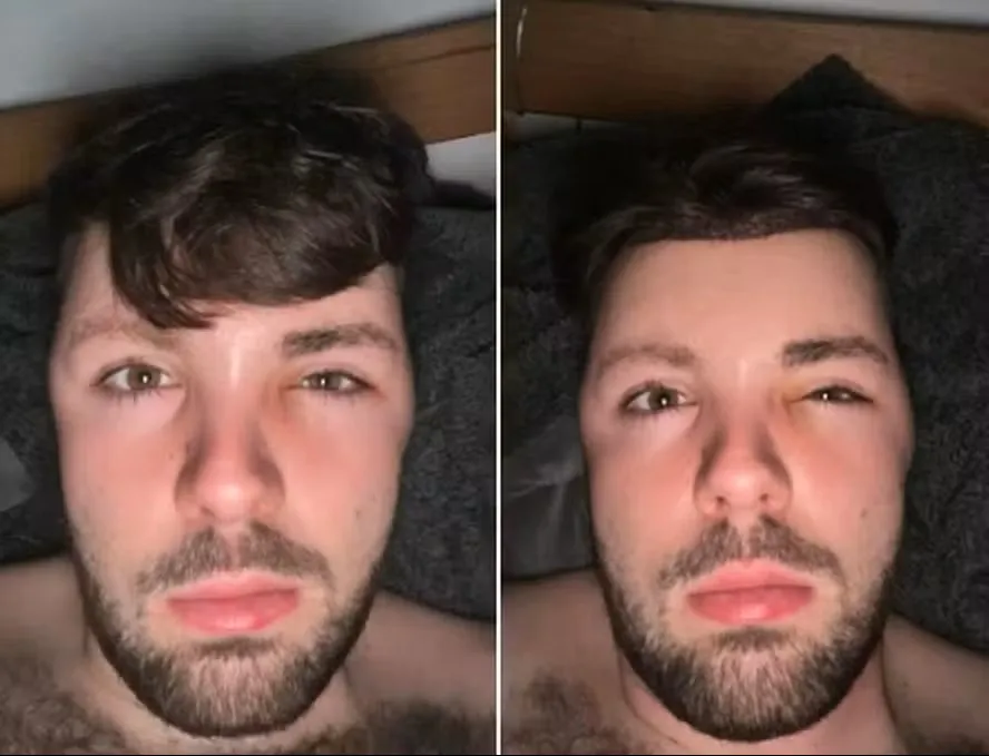 “Cabeça de balão”: homem incha após ignorar proibição de sexo depois de transplante capilar